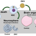vírus zika a malformácie mozgu