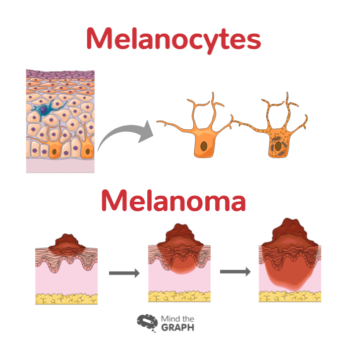 Melanoma Skin Cancer Symptoms And Signs