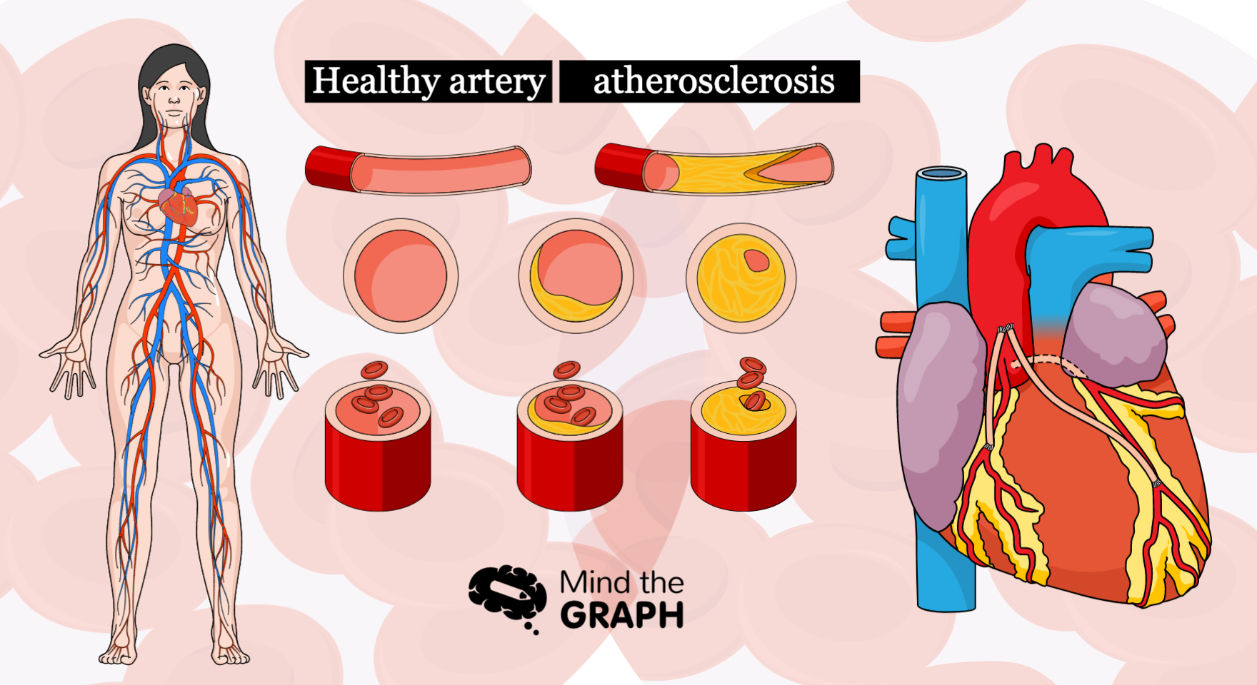 Understanding atherosclerosis through medical illustrations