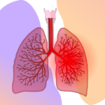 zapalenie płuc