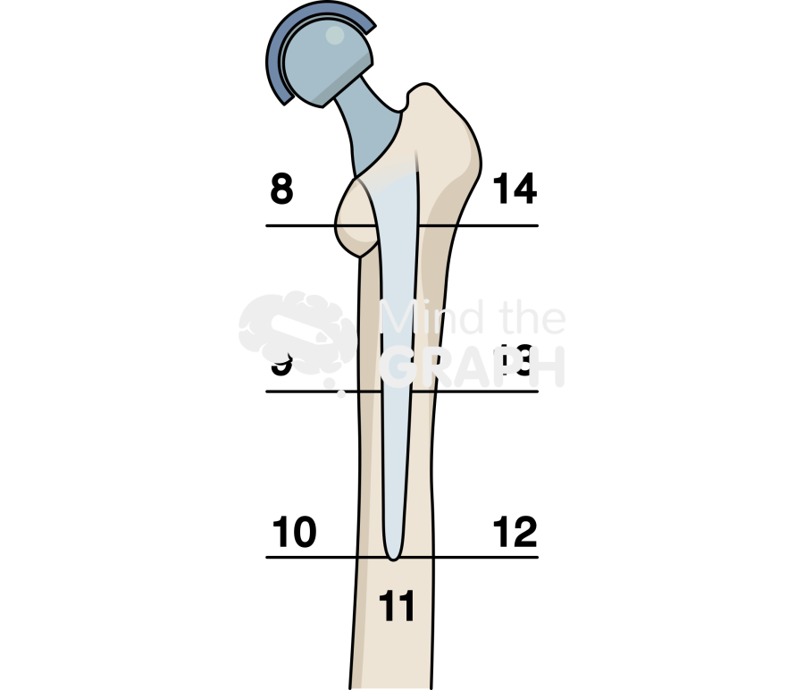 Иллюстрация Mind the Graph: Зоны Груэна Латеральная кость Полная