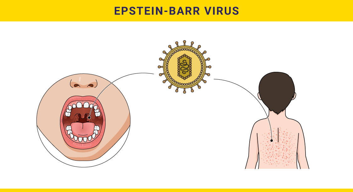 Герпес эпштейн барр. Вирус Эпштейна-Барр пути передачи. Вирус Эпштейна-Барр сыпь. EBV картинка.