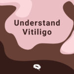 entender-vitiligo-blog1