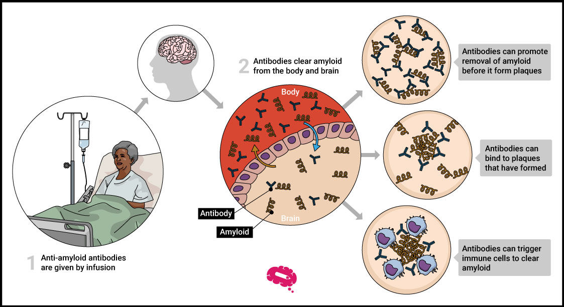 What is lecanemab the new treatment for alzheimer s 