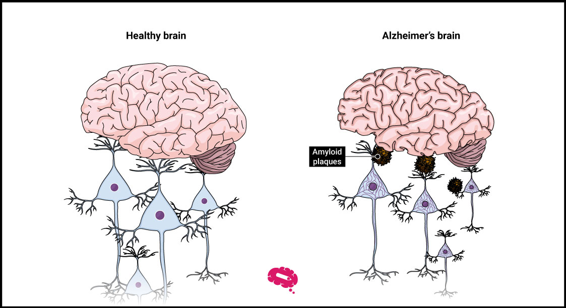 What Is Lecanemab, The New Treatment For Alzheimer's?