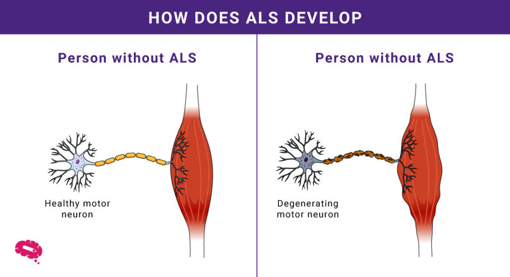 Qué es la esclerosis lateral amiotrófica