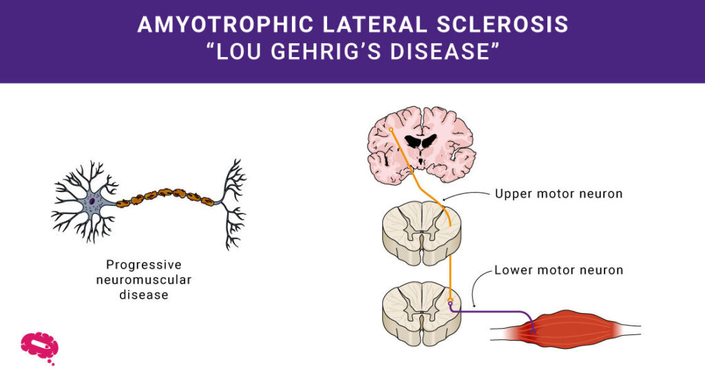 Какво представлява амиотрофичната латерална склероза